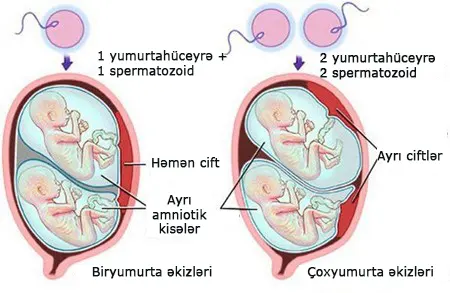 SXEM: Çoxdöllü hamiləliyin növləri