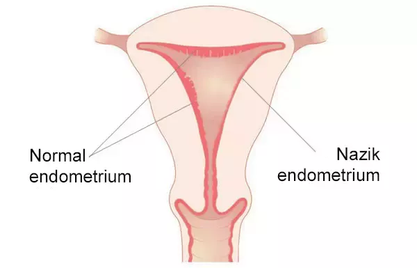 SXEM: Nazik endometrium