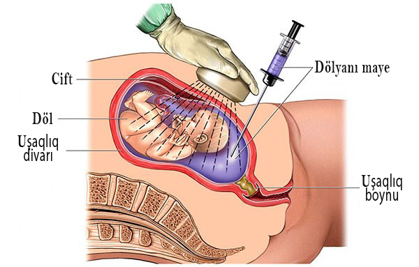 SXEM: Amniosentezdə dölyanı mayenin alınması sxemi