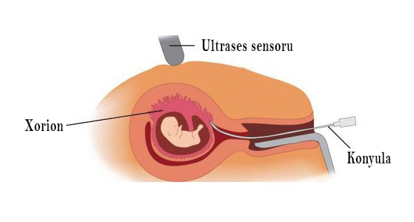 SXEM: Xorionun biopsiyası