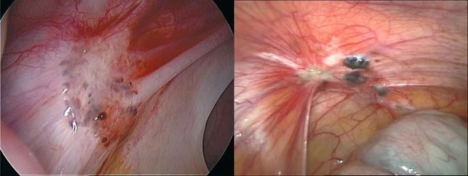 endometriozda laparoskopik mənzərə