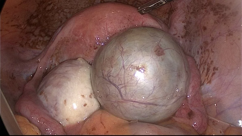 Endometroid kista laparoskopiyada
